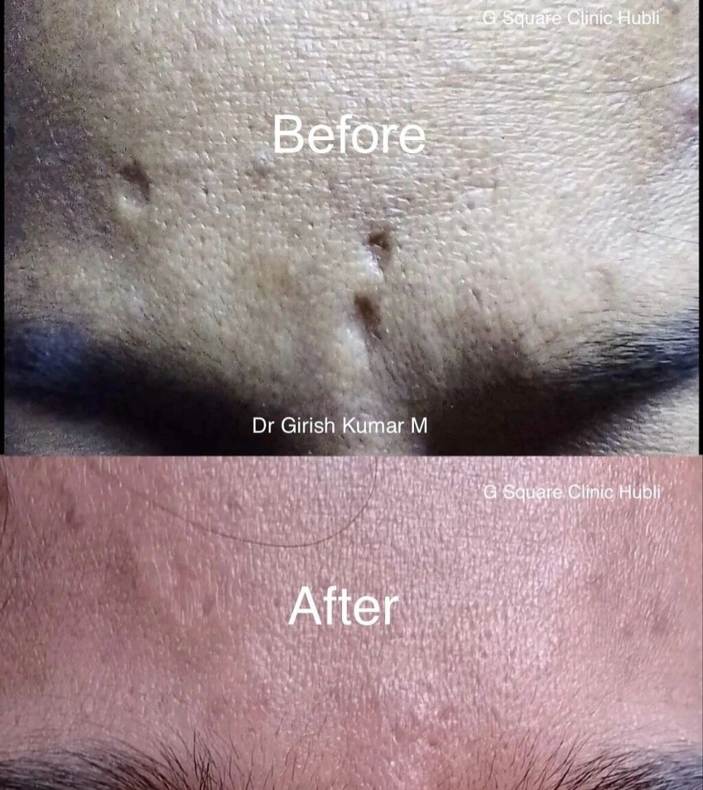 Facial Scar Treatment in Hubli: From Chickenpox Scars to Clear Skin – A Transformational Journey